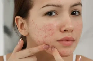 Tips Efektif Menghilangkan Jerawat Batu di Hidung dengan Aman dan Cepat